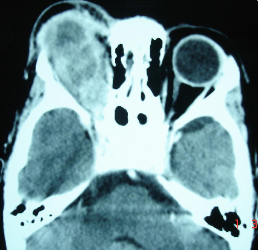 FIGURE-2: TITLE: CT Brain and Orbits (axial view) in a patient of retinoblastoma.