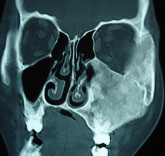 FIGURE-4: TITLE: CT (coronal view) in a patient of fibrous dysplasia.
