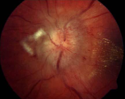 causes of disc swelling Optic neuritis