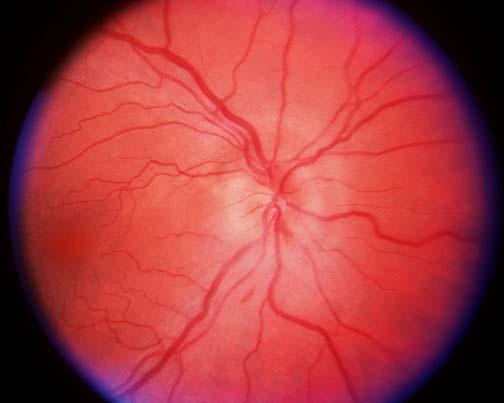 retinal vein occlusion Diabetic