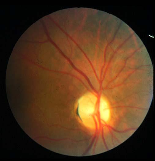 Retrochiasmal lesions Hemianopic scotoma Grossly incongruous field defects Small
