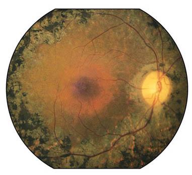 Retinal pigmentary