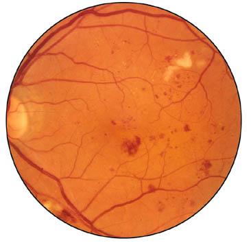 Optic atrophy Krabbe, Metachromatic leukodystrophy Adrenoleukodystrophy, Alexander