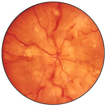 Ocular manifestations of hypertension