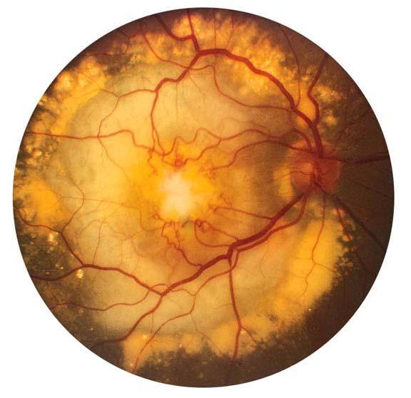 Retinal causes of impaired vision Symptoms Age-related macular degeneration is the most common cause of visual loss > 65 years Diabetic retinopathy is the most common cause of visual loss <
