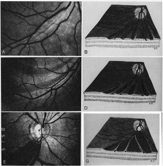 Bilateral optic atrophy with centrocoecal scotoma Hereditary (dominant, Leber s) Toxic (medications,