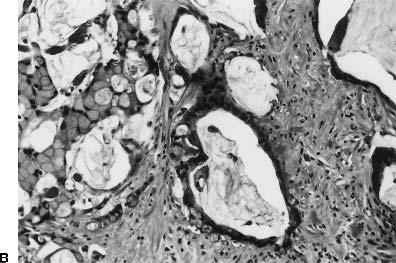 Figure 5 shows a representative staining of metastatic foci in an ovary.