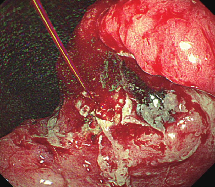 Treatment of Gastric Cancer Bleeding A B Fig. 1. Endoscopic therapy for tumor bleeding due to inoperable gastric cancer using hemoclips.