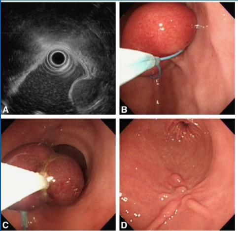 incomplete resection, perforation Endoscopic incision/unroofing and