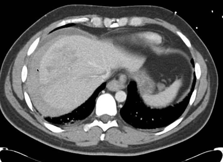 C - Circulation Abdomen Spleen/ Liver laceration is there active bleeding?