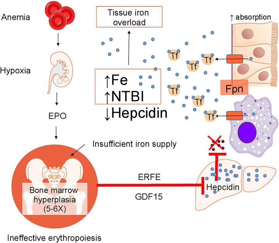 FIG 7 Hepcidin suppression in iron-loading anemias. Ineffective erythropoiesis leads to hepcidin suppression via induction of the erythroid regulators ERFE and GDF15.