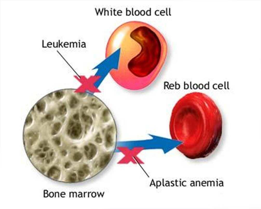 APLASTIC ANEMIA Bone marrow does not produce enough red