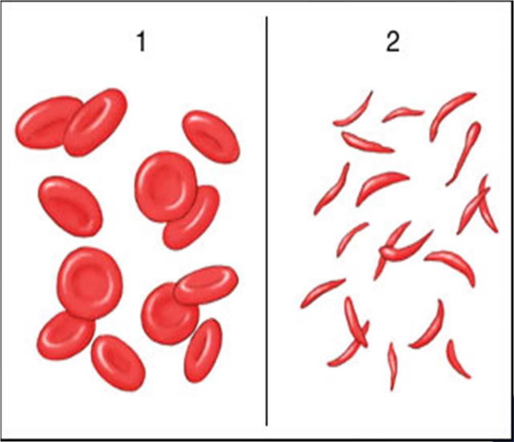 SICKLE CELL ANEMIA Chronic blood disease inherited from both parents Causes the red cells to form in abnormal