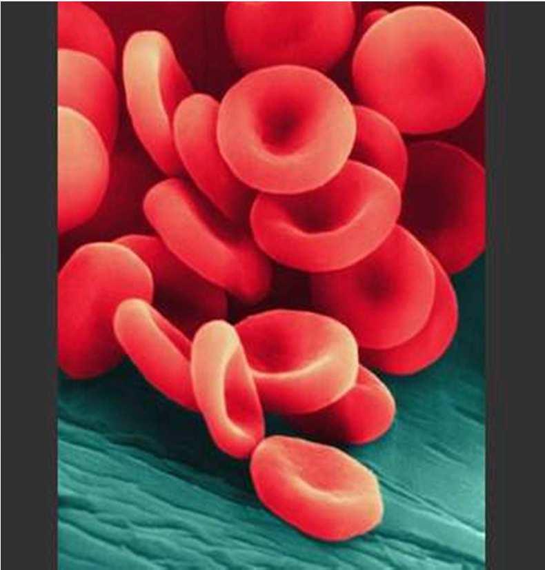 Erythrocytes-Red Blood Cell Shape = biconcave discs RBC HEMOGLOBIN gives red color, heme is iron and globin is