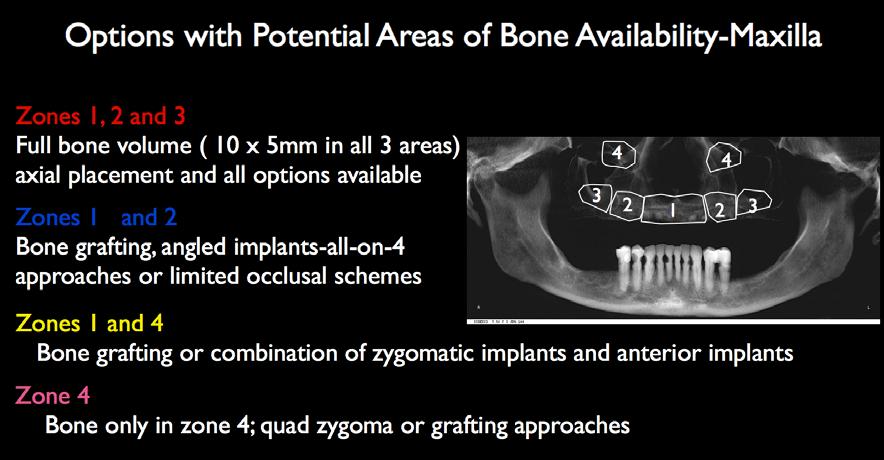 Figure 2. Radiographic zones of bone volume availability relative to implant restorative options in the maxilla.