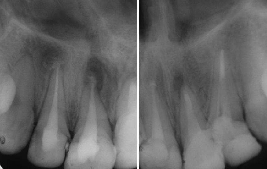 The ptient ws clled for routine controls for out 1 yer fter the endodontic tretment (then ws clled in 1-yer intervls) nd no prolem ws oserved (Figure