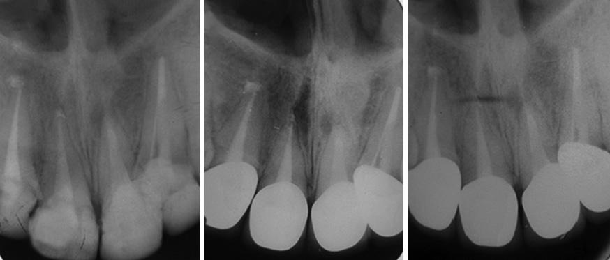 After endodontic tretment, peripicl lesions were heled, the ptient s gums were helthy, nd there were no symptoms of sensitivity to percussion, plption
