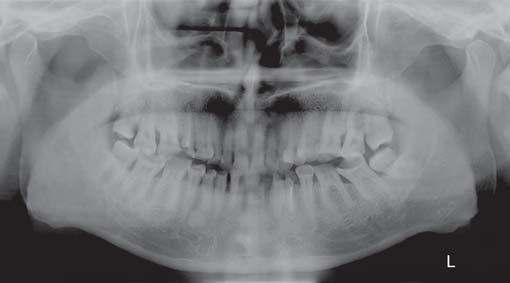 Maxillary left second and third molars showed poor prognosis and were advised for extraction.