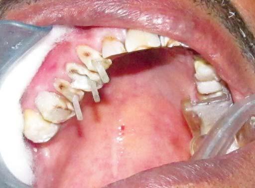 Once the provisional restorations were equilibrated and esthetics and phonetics were deemed satisfactory, an occlusal bite record was made of the maxillary and mandibular provisional restorations.