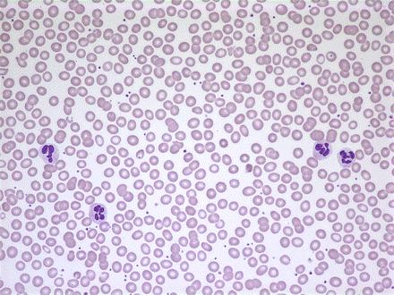 reticulocytes Peripheral blood smear