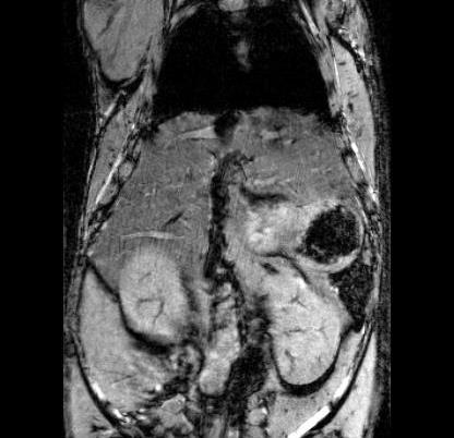 Agent-assisted MRI Loss signal/dark image =