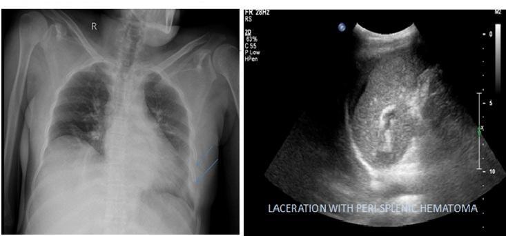 VI) FIGURES Fig 1. Left: Chest radiograph AP view showing left lower rib fractures.