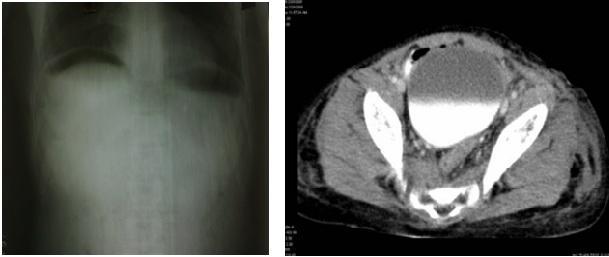Fig 2. Left: Plain Radiograph Of Erect Abdomen Free Air Under Right Doom Of Diaphragm.