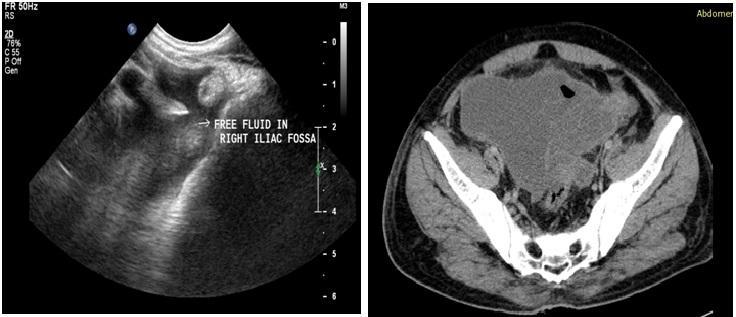 Fig 4. Left: Ultrasonography showing free fluid with internal echoes in right iliac fossa- hemoperitoneum.
