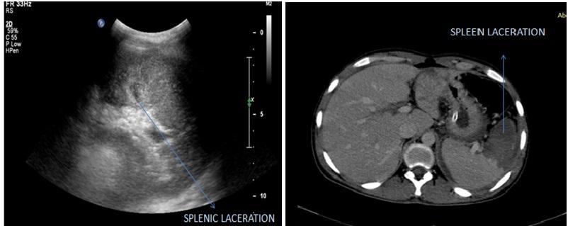 Fig 6. Left: Ultrasonography of spleen laceration with perisplenic collection.