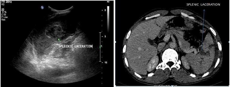 7. Left: Ultrasonography Of Splenic Grade II Laceration Extending From Medial Margin To Deep Into Parenchyma.