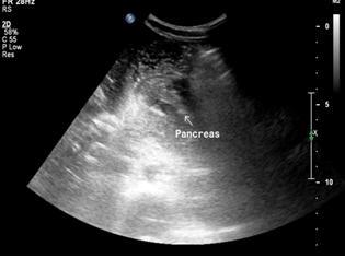 Fig 9. Ultrasonography of pancreas grade II laceration through the head of pancreas. Fig 10.