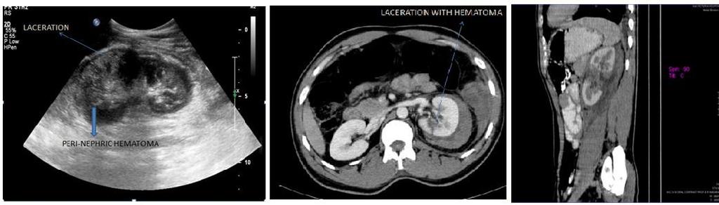 Middle: Axial CECT image of abdomen- left kidney laceration with perinephric hematoma.