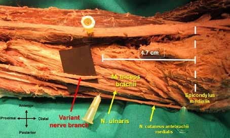 Given our measurements, the variant nerve Table I: Morphometric Data of the Variant Nerve Branch Parameters Length of upper arm Length of variant nerve branch Diameter of variant nerve branch