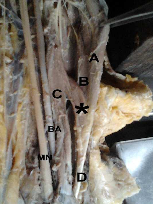 median nerve to brachial artery in the left upper limb.