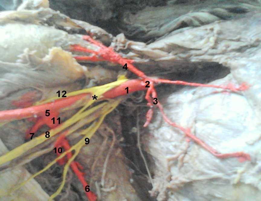 Page 84 Asian Journal of Medical Sciences 5(2014) 81-85 Figure -3 showing variation in branching pattern of axillary artery, slender lateral root forming median nerve, medial positioning of median