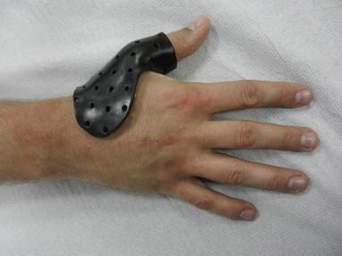 MCP joint instability MCPJ laxity predisposes patients to OA of the thumb (Degreef, De Smet 2006) MCPJ hyperextension with mild CMCJ symptoms & minimal