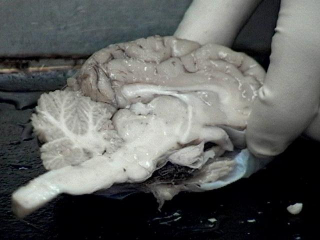 Lateral ventricle Third ventricle