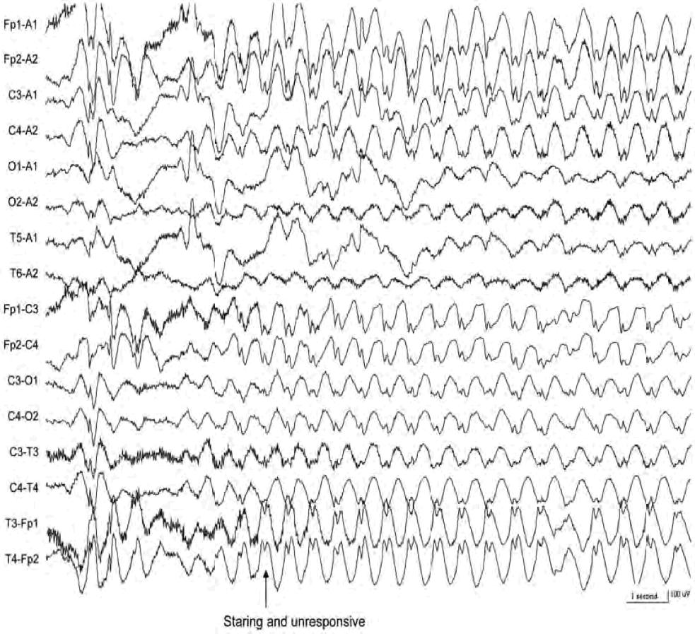 4. Generalised Slow Spike Wave OVen sharp and slow waves rather than spike and slow wave Frequency 1-2 Hz Prolonged runs with no clinical signs Diffusely distributed but may be seen in anterior