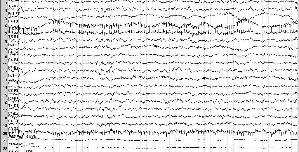6 Hz Spike and Slow Wave 2 main pa:erns W: waking H: high amplitude A: anterior M: males