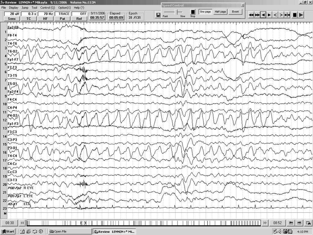 Occipital Intermi:ent Rhythmic Delta Ac-vity OIRDA Common in CAE (33%) and also seen in JAE Can occur in long runs (minutes) Not an ictal pa2ern Good prognos.