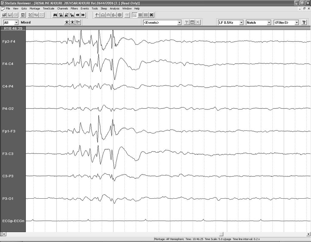 short in duration (about 10 ms) 2) followed by a positive transient lasting 100 150 ms, which continues into; 3)