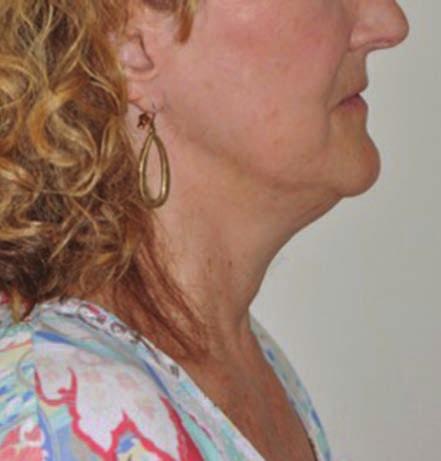 PEER-REVIEW COMBINATIONAL TREATMENTS Figure 4 (A) before (B) after views of a woman in her late 50s who was looking to non-surgically improve her jawline and obtain neck tightening, and underwent