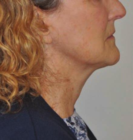 Figure 5 (A) Before (B) after of a woman in her late 70s who was interested in non-surgical lipolysis and improvement of her submental area and neck tissue tightening.