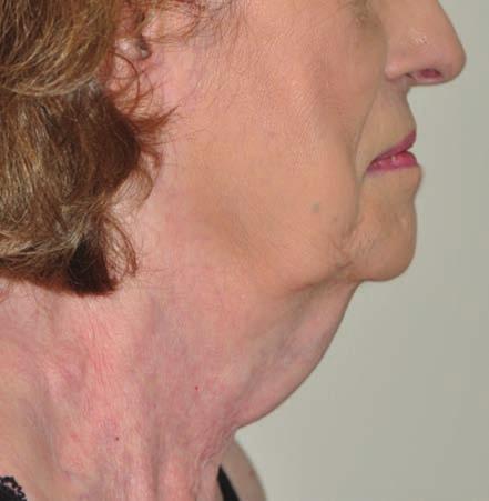 COMBINATIONAL TREATMENTS PEER-REVIEW Key points neck and/or jawline, thin skin thickness, mild platysmal banding, crepey neck skin, or poor skin elasticity.