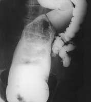 Radiograph showing megacolon secondary to rectal impaction View larger version (132K): [in this window] [in a new window] Diarrhoea Top Prevalence of constipation Assessment of constipation Managing