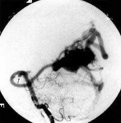 296 Stapf, Mohr, Pile-Spellman, et al Figure 1 Feeding artery aneurysm (arrow) on a posterior cerebral artery feeding a right occipital brain arteriovenous malformation (vertebral artery injection).