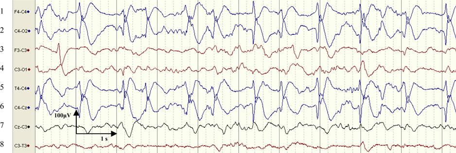 9 Example of a neonatal seizure a focal