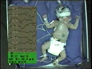 Electroclinical uncoupling of neonatal seizures