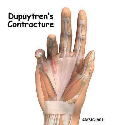 Introduction Dupuytren's contracture is a fairly common disorder of the fingers. It most often affects the ring or little finger, sometimes both, and often in both hands.