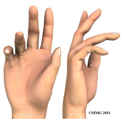 shorten until the finger cannot be fully straightened. Dupuytren's contracture usually affects only the ring and little finger.